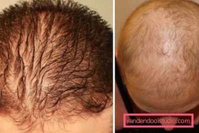 stadij alopecije stadij alopecije
