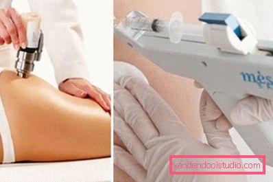 mezoterapija za mršavljenje mezoterapija za mršavljenje