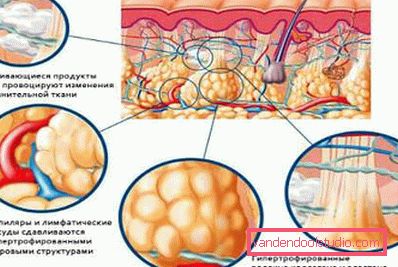 celulitis