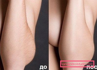 žensku podlakticu prije i poslije lijeka žensku podlakticu prije i poslije lijeka