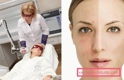 savršena koža nakon lasera savršena koža nakon lasera