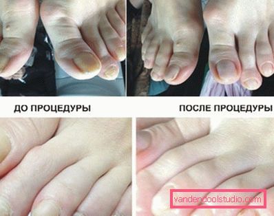 prije i poslije postupka prije i poslije postupka