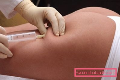 injekcija za mršavljenje ozona injekcija za mršavljenje ozona